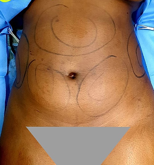 Liposuction Before & After