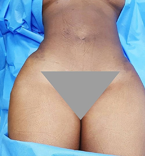 Liposuction Before & After