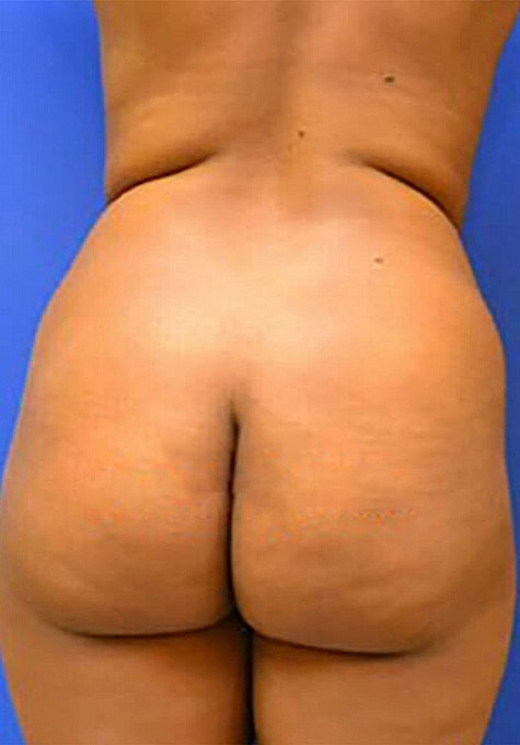 Liposuction Before & After