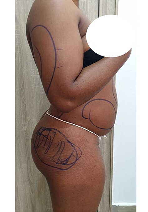 Liposuction Before & After