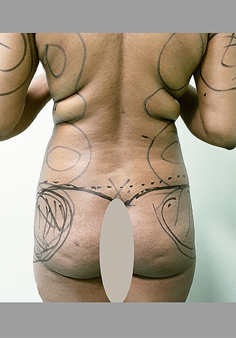 Liposuction Before & After