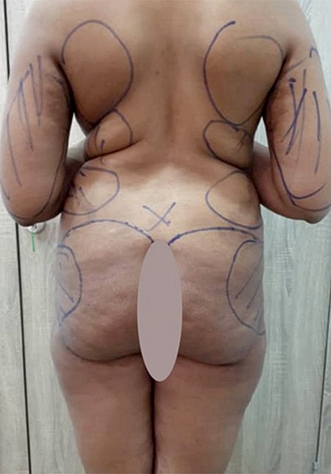 Liposuction Before & After