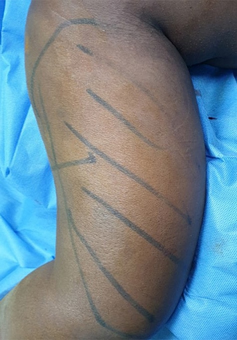 Liposuction Before & After