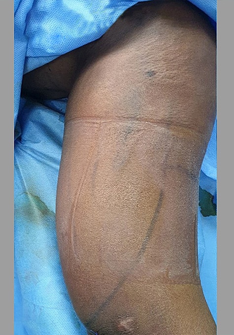 Liposuction Before & After