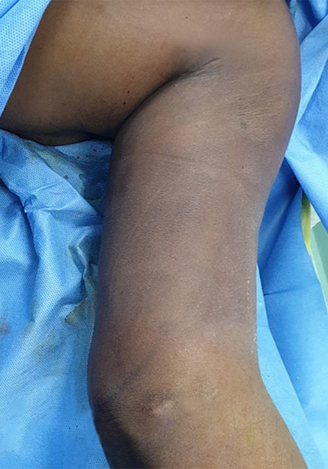 Liposuction Before & After