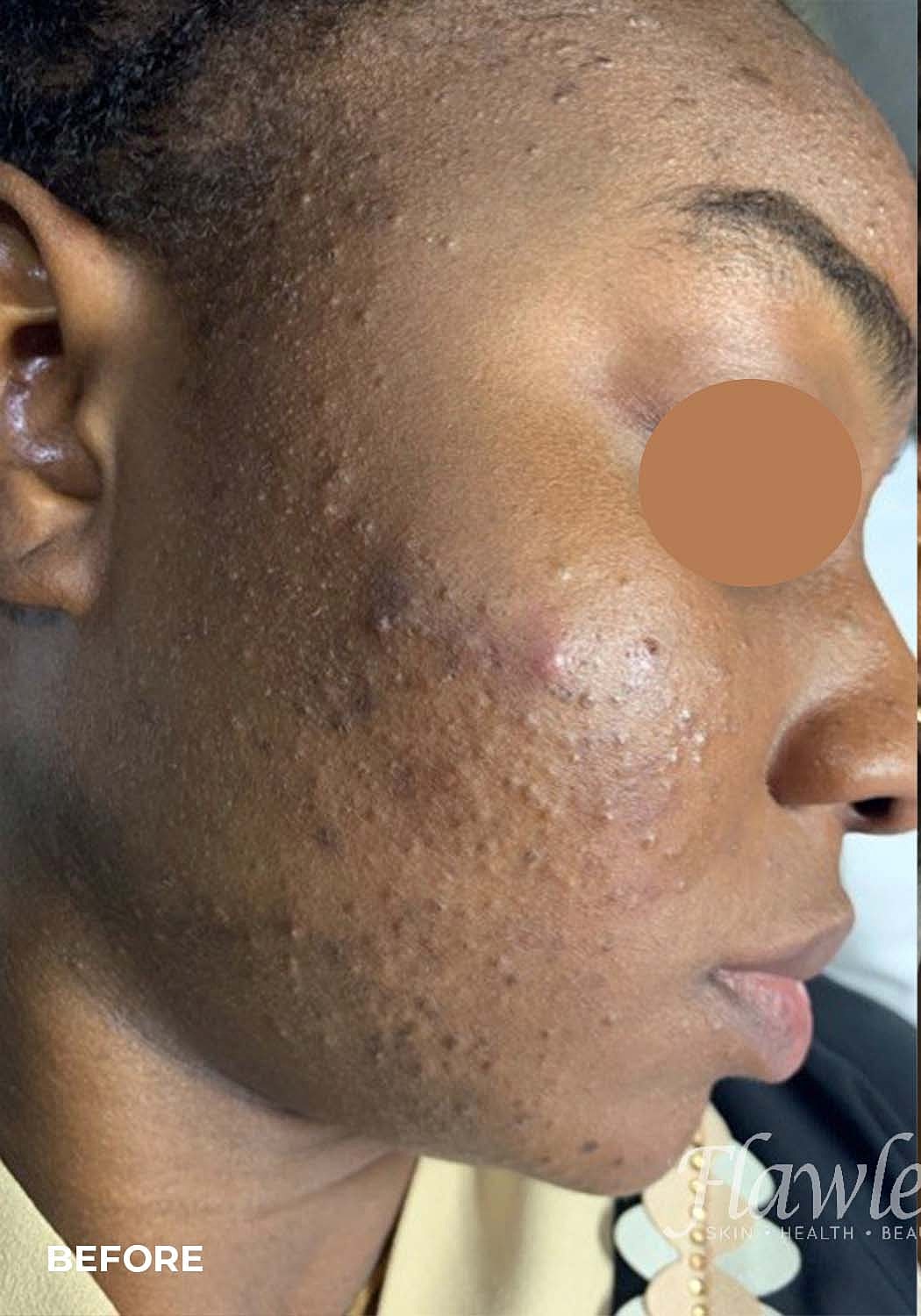 Acne Facial Procedure Before & After