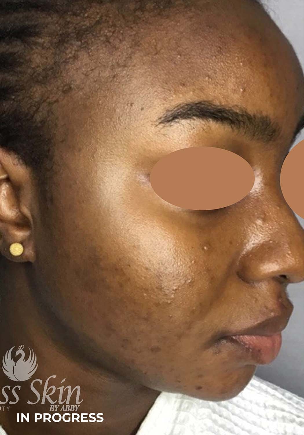 Acne Facial Procedure Before & After