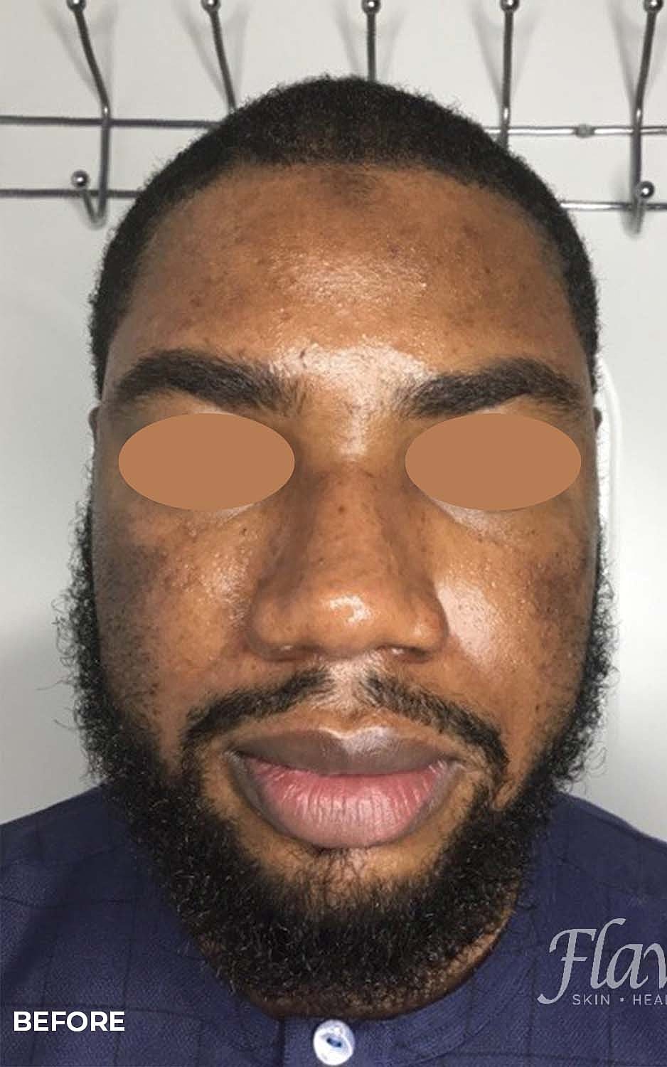 Acne Facial Procedure Before & After