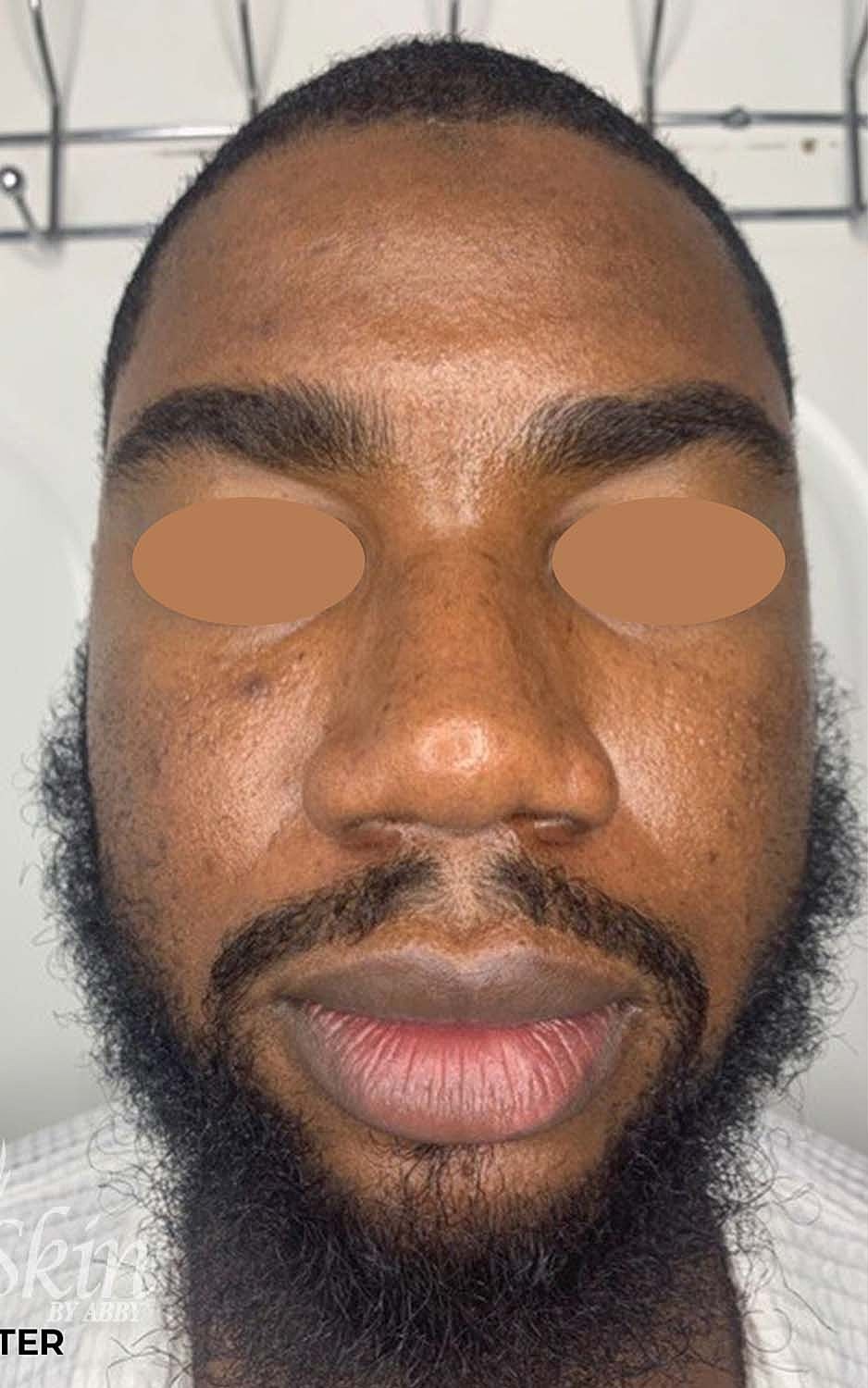 Acne Facial Procedure Before & After