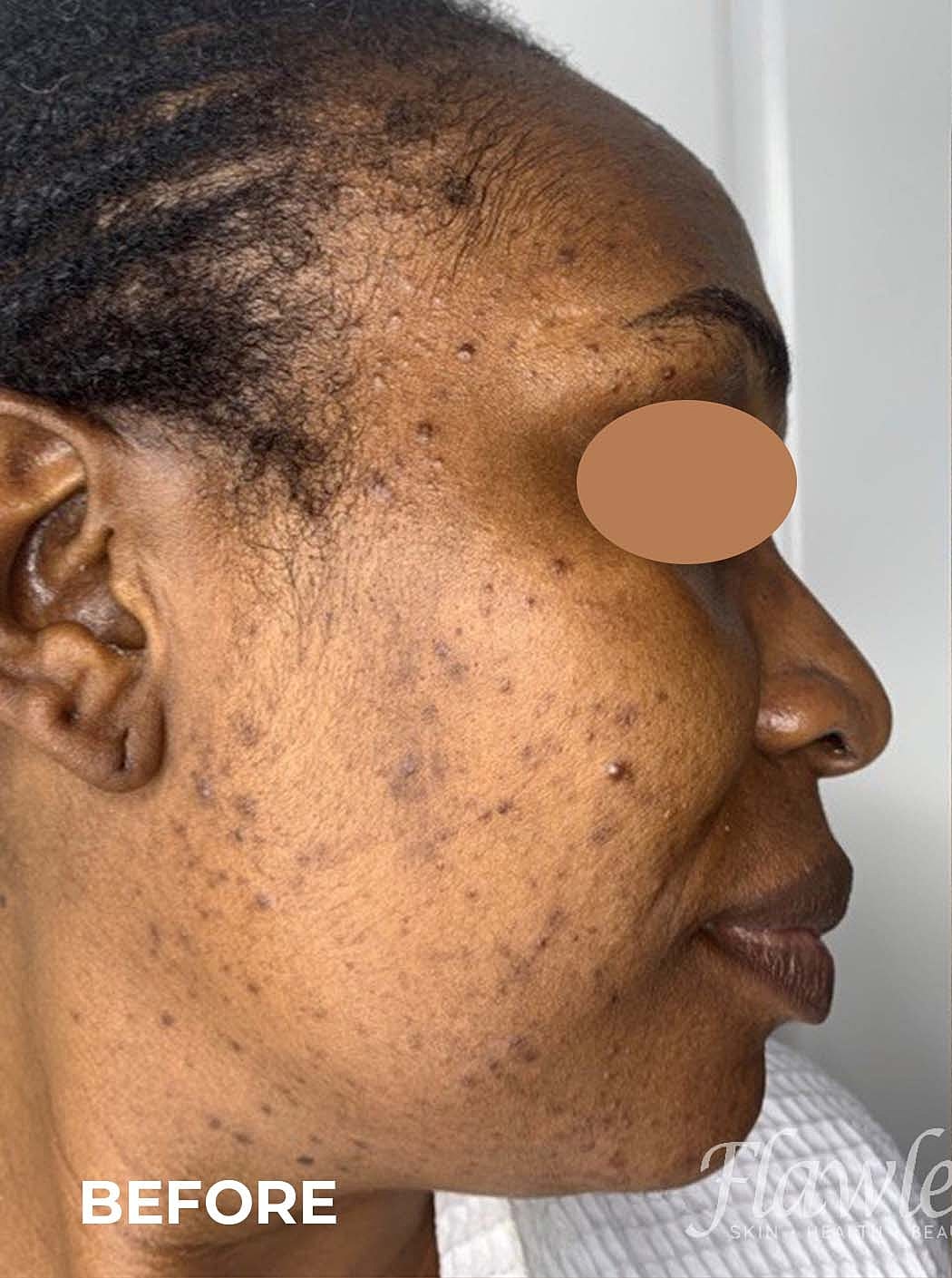 Acne Facial Procedure Before & After