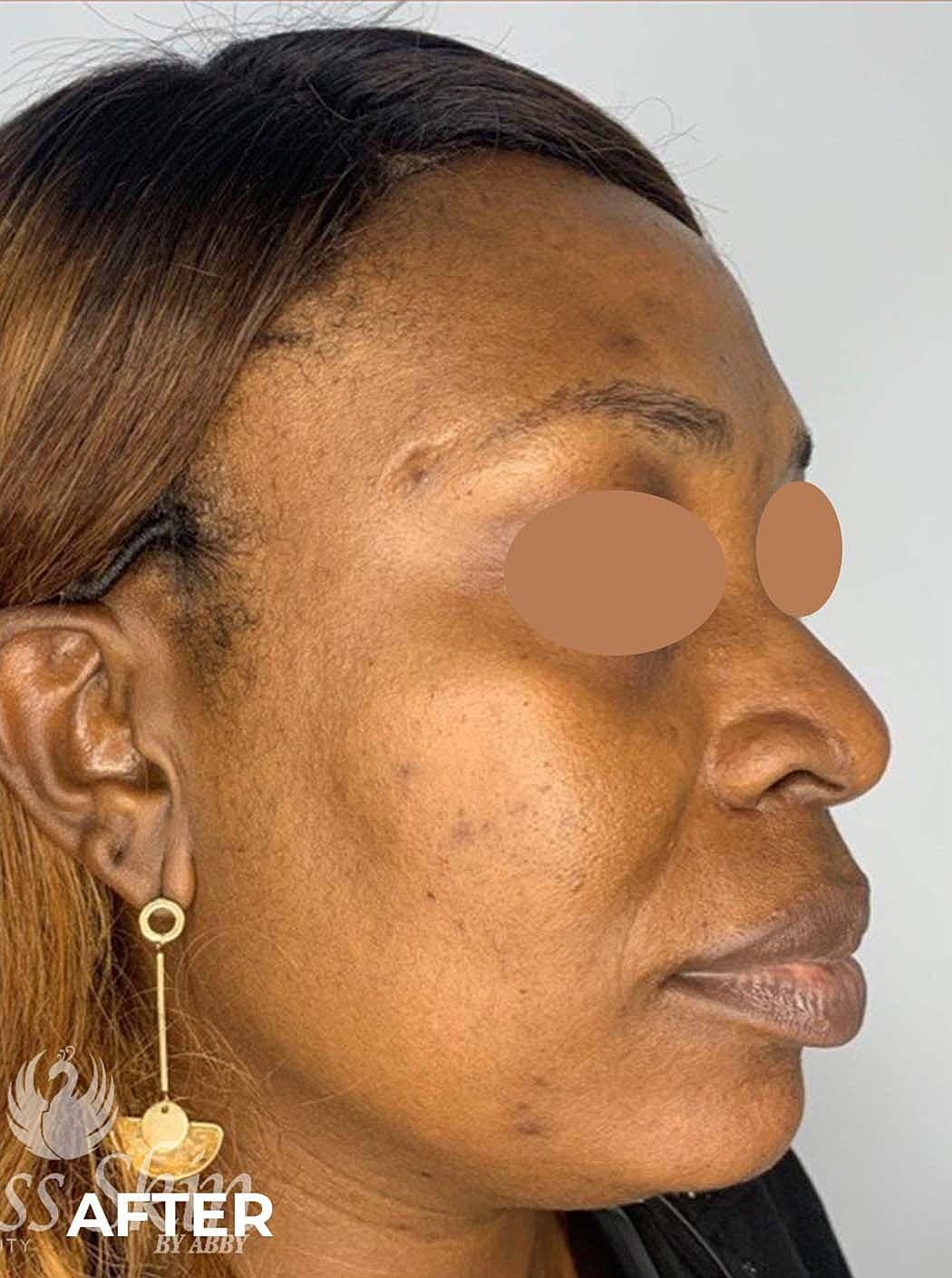 Acne Facial Procedure Before & After