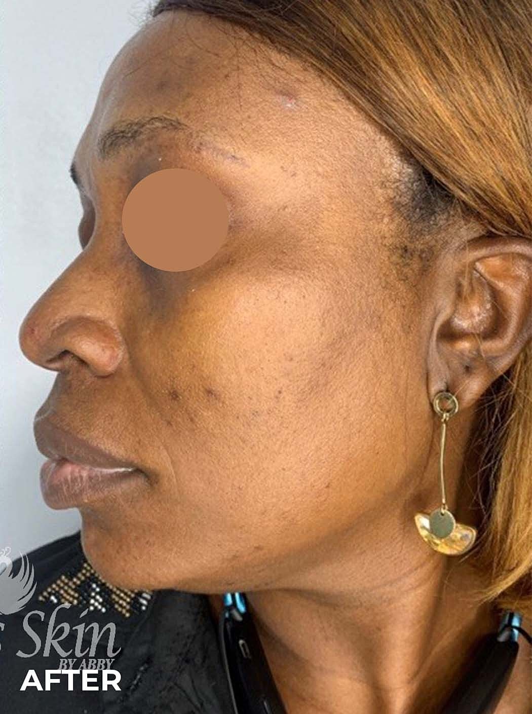 Acne Facial Procedure Before & After