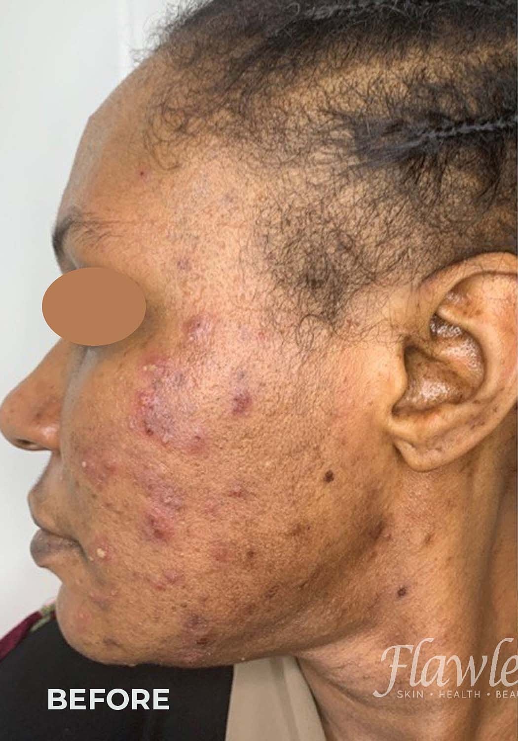 Acne Facial Procedure Before & After