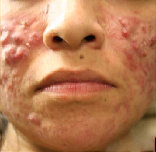 Acne Facial Procedure Before & After