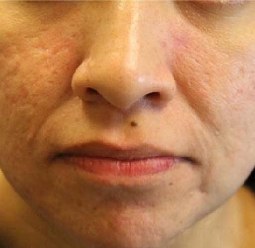 Acne Facial Procedure Before & After