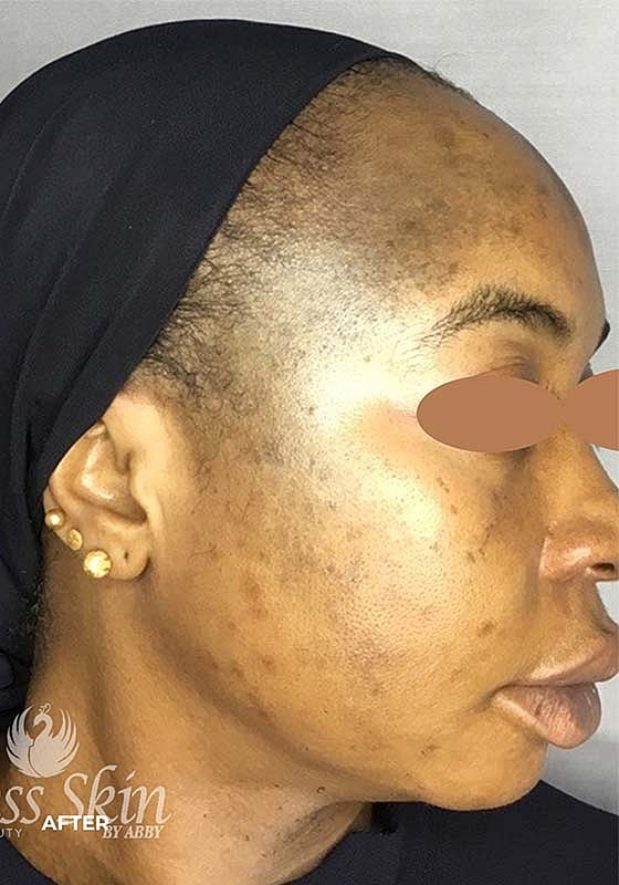 Acne Facial Procedure Before & After