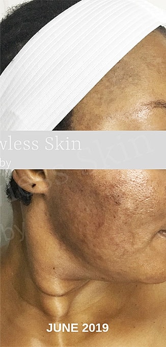 Acne Facial Procedure Before & After