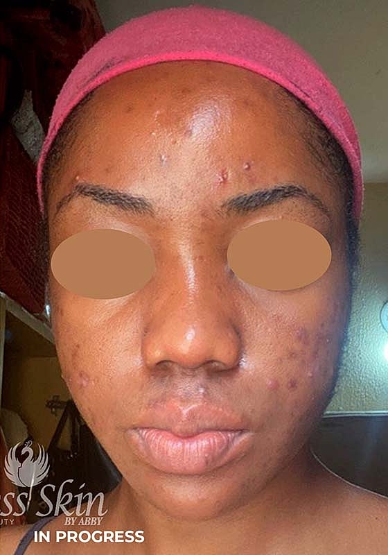 Acne Facial Procedure Before & After
