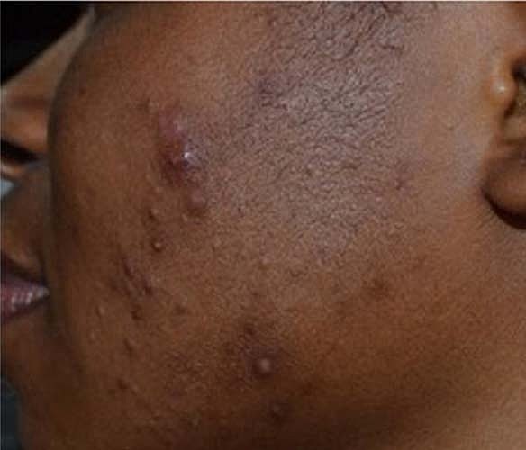 Acne Facial Procedure Before & After