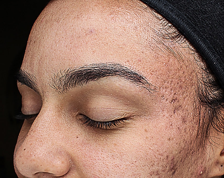 Acne Facial Procedure Before & After