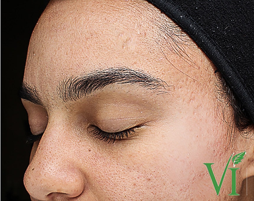 Acne Facial Procedure Before & After