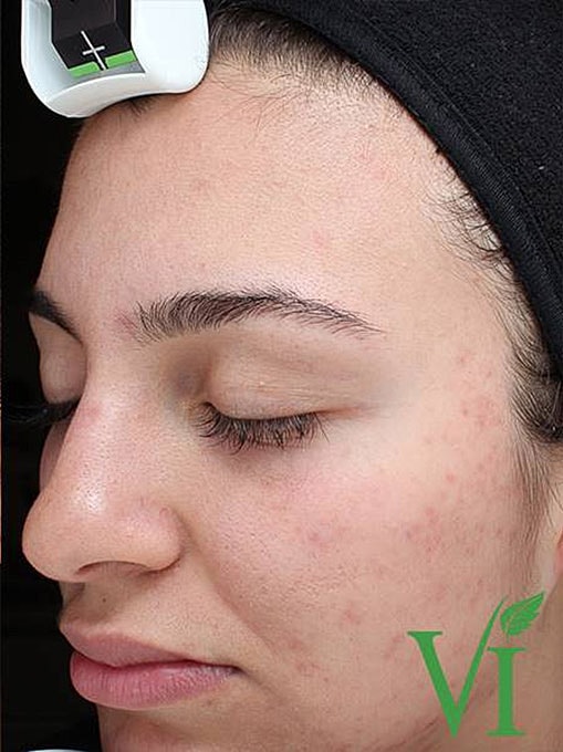 Acne Facial Procedure Before & After