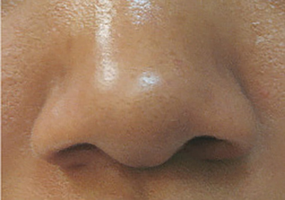 Acne Facial Procedure Before & After