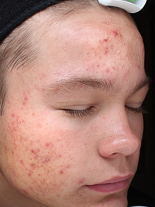 Acne Facial Procedure Before & After