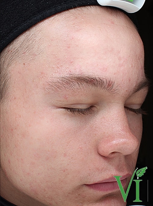 Acne Facial Procedure Before & After