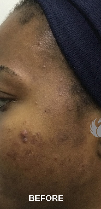 Acne Facial Procedure Before & After