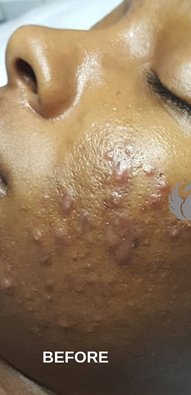 Acne Facial Procedure Before & After
