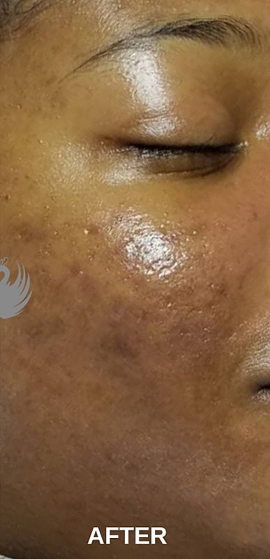 Acne Facial Procedure Before & After