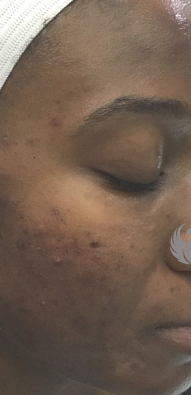 Acne Facial Procedure Before & After