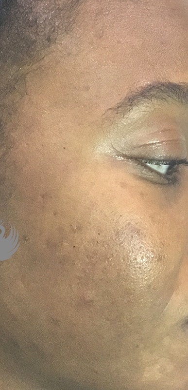 Acne Facial Procedure Before & After