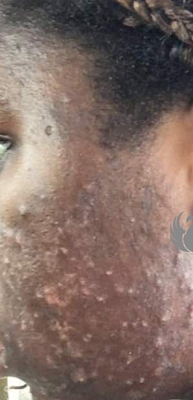 Acne Facial Procedure Before & After