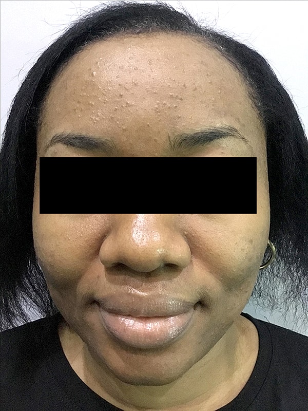 Acne Facial Procedure Before & After