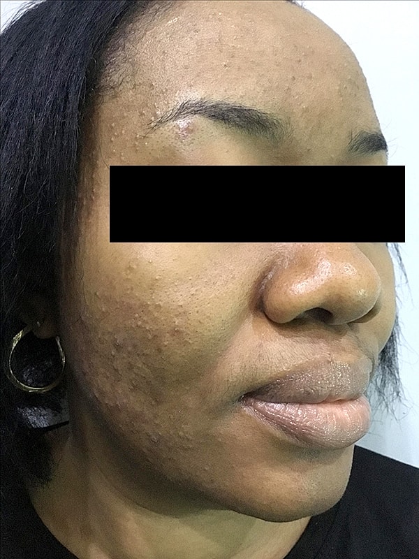 Acne Facial Procedure Before & After