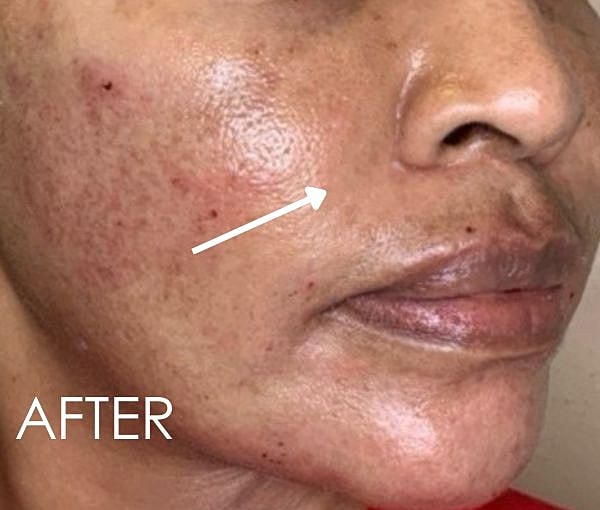 PDO Thread Lift Before & After