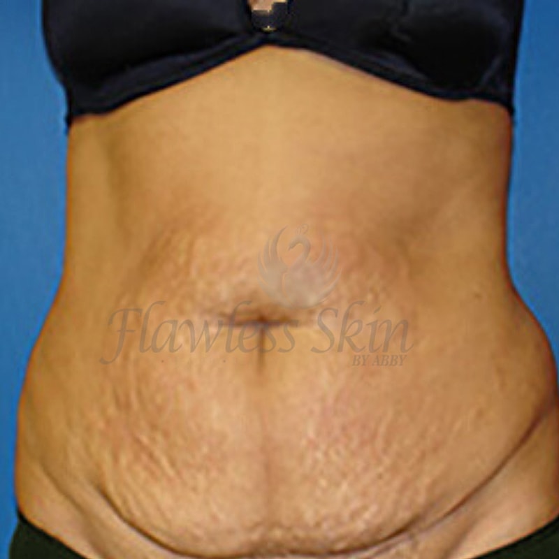 Tummy Tuck Before & After