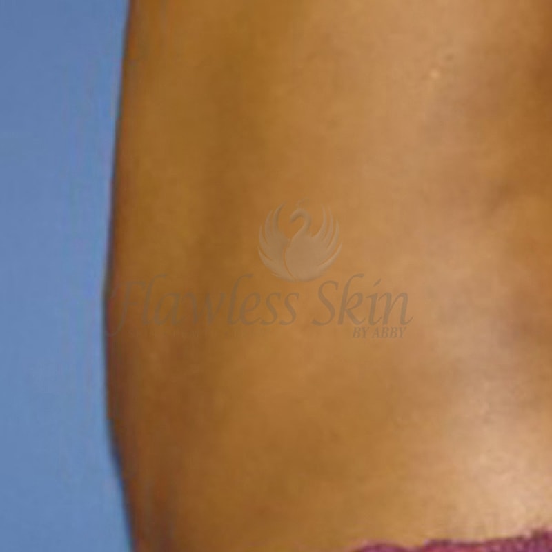 Tummy Tuck Before & After