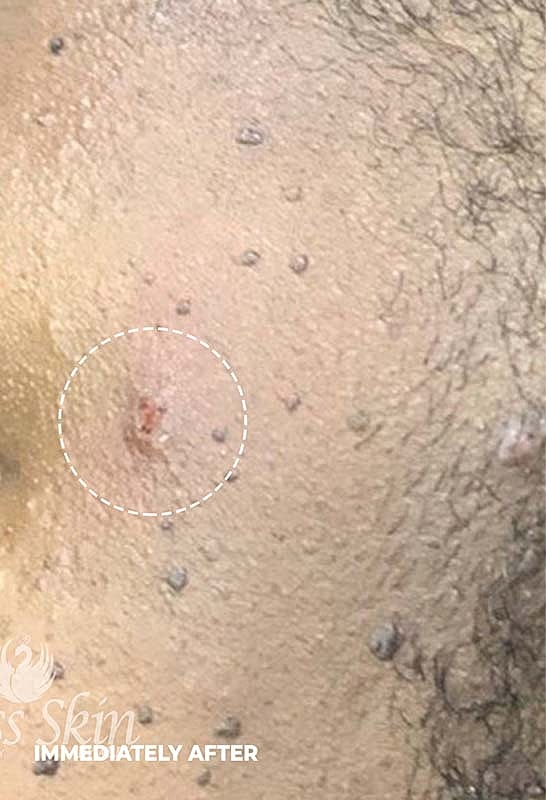 Skin Tag Removal Before & After