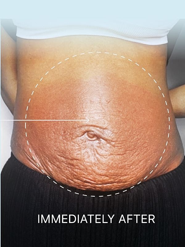 Post-treatment image of textured abdominal skin.