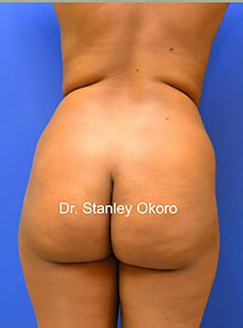 Brazilian Butt Lift  Before & After