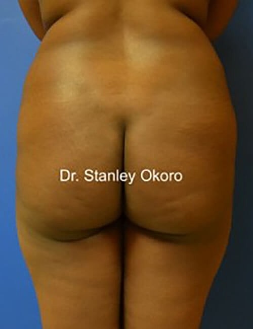 Brazilian Butt Lift  Before & After