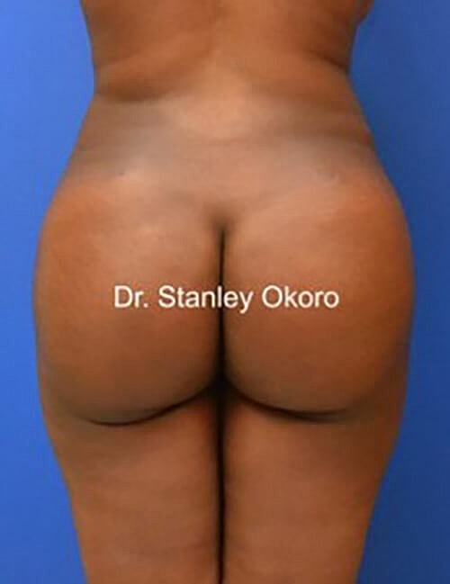 Brazilian Butt Lift  Before & After