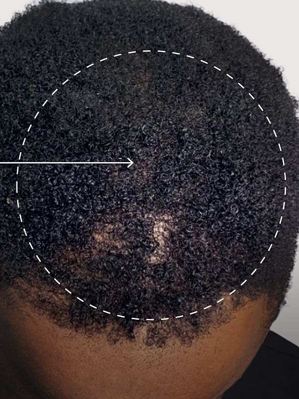 Hair loss patch on textured hair.
