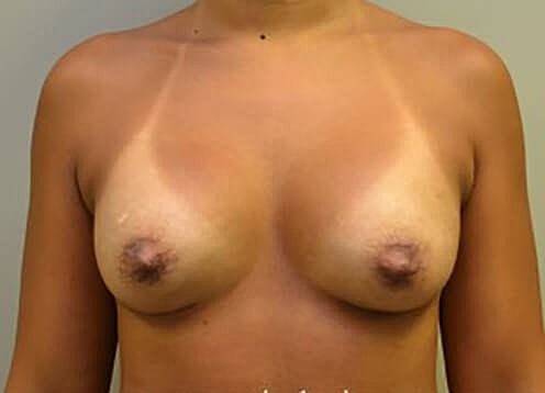 Breast Augmentation And Breast Lift Before & After