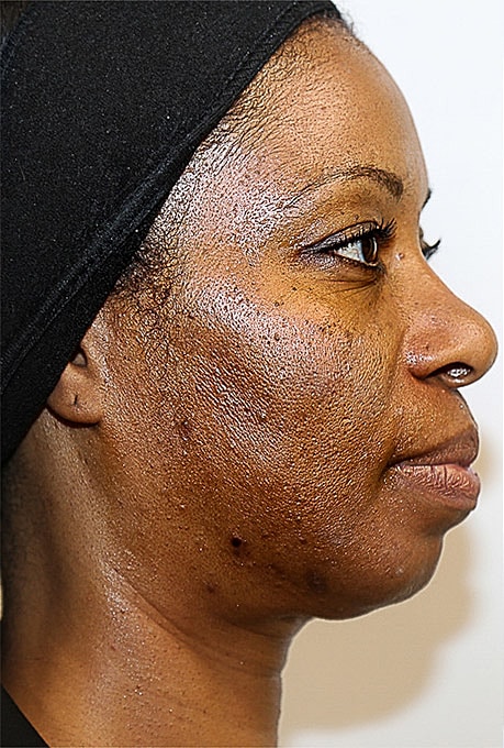 Hyperpigmentation Before & After
