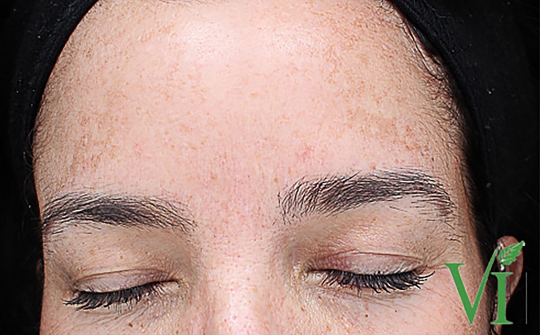 Hyperpigmentation Before & After