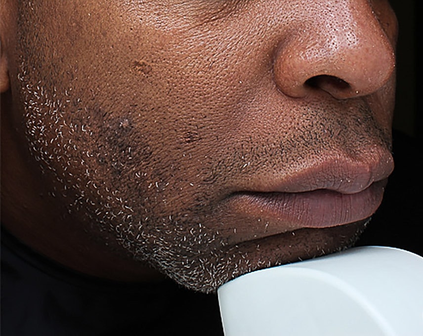 Hyperpigmentation Before & After